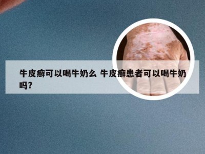 牛皮癣可以喝牛奶么 牛皮癣患者可以喝牛奶吗?
