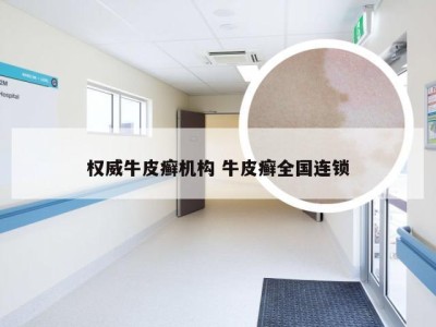 权威牛皮癣机构 牛皮癣全国连锁
