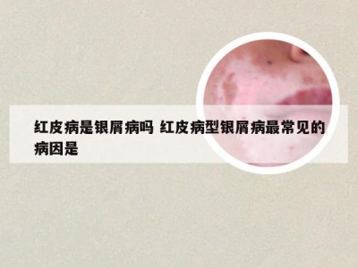 红皮病是银屑病吗 红皮病型银屑病最常见的病因是