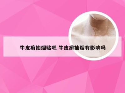 牛皮癣抽烟贴吧 牛皮癣抽烟有影响吗