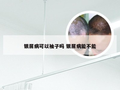 银屑病可以袖子吗 银屑病能不能