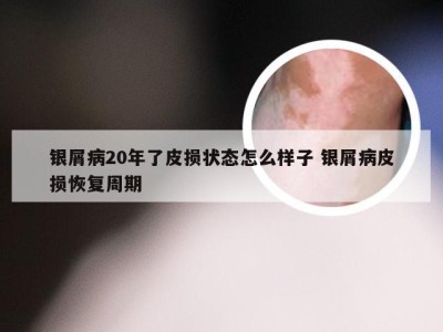 银屑病20年了皮损状态怎么样子 银屑病皮损恢复周期