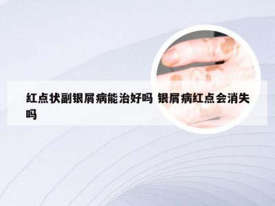 红点状副银屑病能治好吗 银屑病红点会消失吗