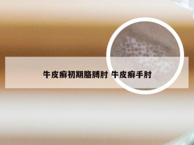 牛皮癣初期胳膊肘 牛皮癣手肘