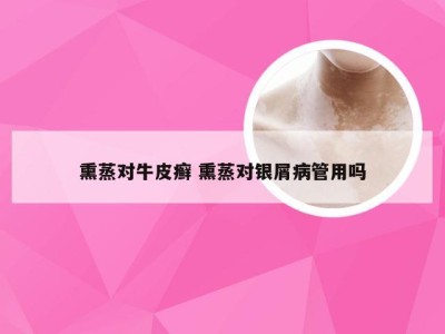 熏蒸对牛皮癣 熏蒸对银屑病管用吗