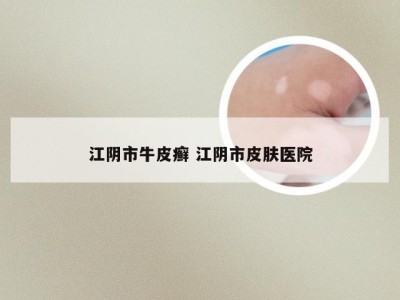 江阴市牛皮癣 江阴市皮肤医院
