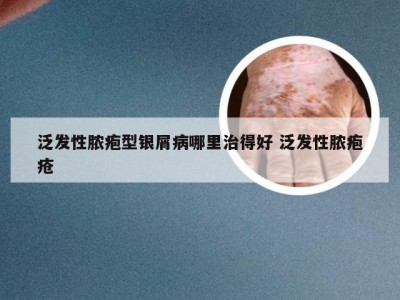 泛发性脓疱型银屑病哪里治得好 泛发性脓疱疮
