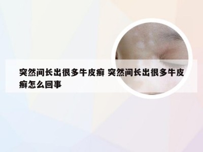 突然间长出很多牛皮癣 突然间长出很多牛皮癣怎么回事