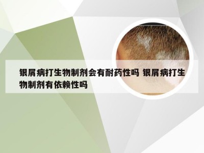 银屑病打生物制剂会有耐药性吗 银屑病打生物制剂有依赖性吗