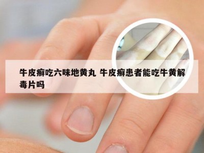 牛皮癣吃六味地黄丸 牛皮癣患者能吃牛黄解毒片吗