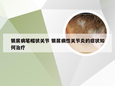 银屑病笔帽状关节 银屑病性关节炎的症状如何治疗