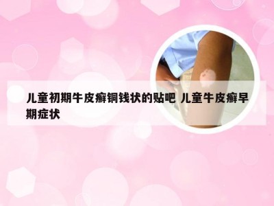 儿童初期牛皮癣铜钱状的贴吧 儿童牛皮癣早期症状