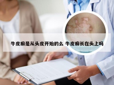 牛皮癣是从头皮开始的么 牛皮癣长在头上吗