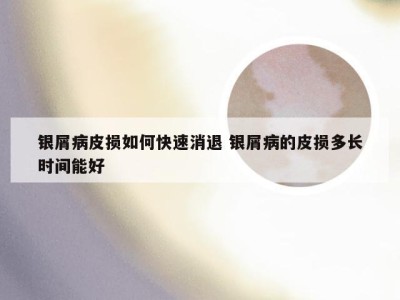 银屑病皮损如何快速消退 银屑病的皮损多长时间能好