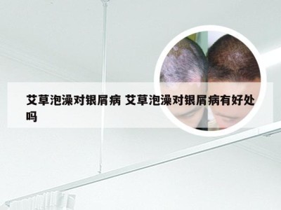 艾草泡澡对银屑病 艾草泡澡对银屑病有好处吗