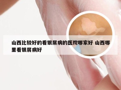 山西比较好的看银屑病的医院哪家好 山西哪里看银屑病好