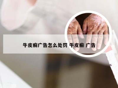 牛皮癣广告怎么处罚 牛皮癣 广告