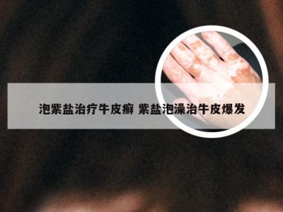 泡紫盐治疗牛皮癣 紫盐泡澡治牛皮爆发