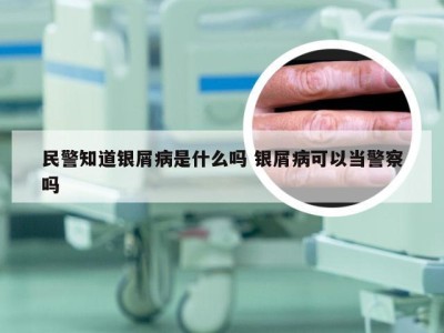 民警知道银屑病是什么吗 银屑病可以当警察吗