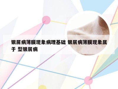 银屑病薄膜现象病理基础 银屑病薄膜现象属于 型银屑病