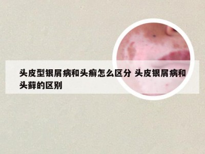 头皮型银屑病和头癣怎么区分 头皮银屑病和头藓的区别