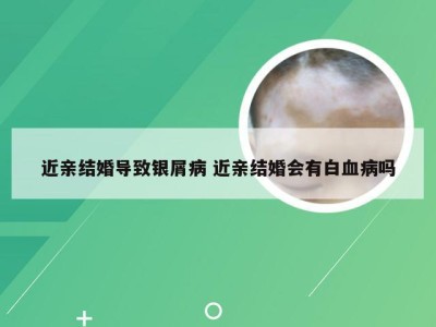 近亲结婚导致银屑病 近亲结婚会有白血病吗