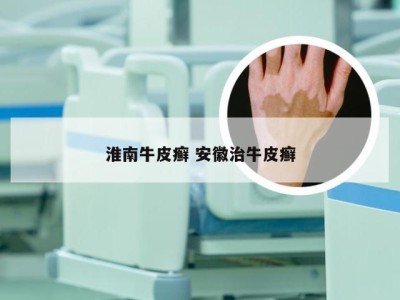 淮南牛皮癣 安徽治牛皮癣