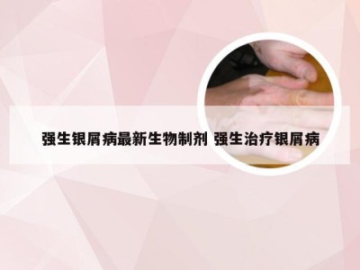 强生银屑病最新生物制剂 强生治疗银屑病