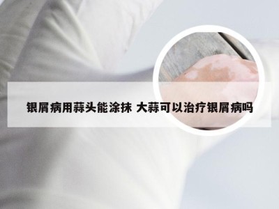 银屑病用蒜头能涂抹 大蒜可以治疗银屑病吗