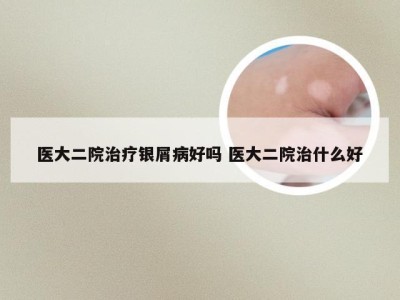 医大二院治疗银屑病好吗 医大二院治什么好