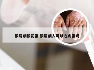 银屑病松花蛋 银屑病人可以吃皮蛋吗