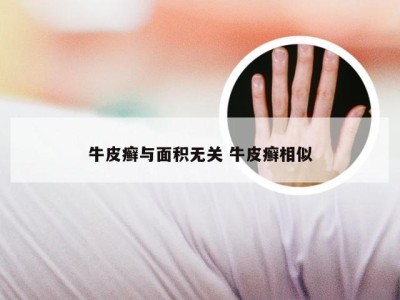 牛皮癣与面积无关 牛皮癣相似
