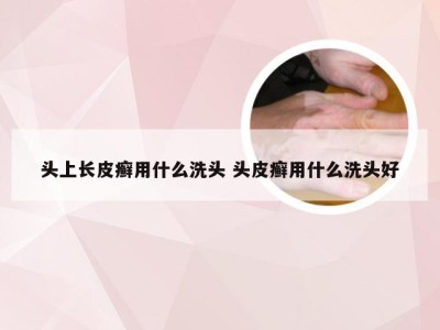 头上长皮癣用什么洗头 头皮癣用什么洗头好