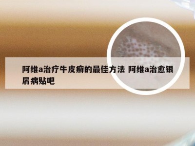 阿维a治疗牛皮癣的最佳方法 阿维a治愈银屑病贴吧
