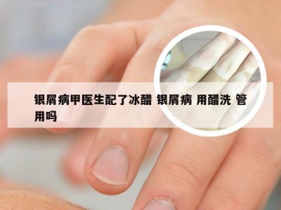 银屑病甲医生配了冰醋 银屑病 用醋洗 管用吗