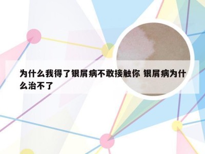为什么我得了银屑病不敢接触你 银屑病为什么治不了