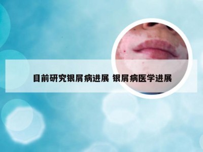 目前研究银屑病进展 银屑病医学进展