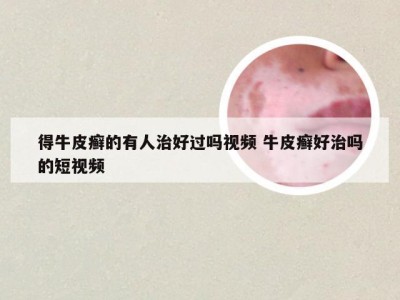 得牛皮癣的有人治好过吗视频 牛皮癣好治吗的短视频