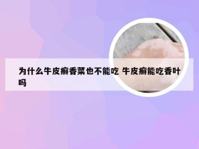 为什么牛皮癣香菜也不能吃 牛皮癣能吃香叶吗
