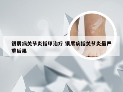 银屑病关节炎指甲治疗 银屑病指关节炎最严重后果