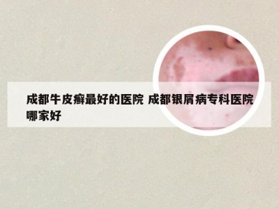 成都牛皮癣最好的医院 成都银屑病专科医院哪家好