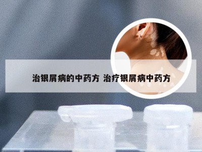 治银屑病的中药方 治疗银屑病中药方
