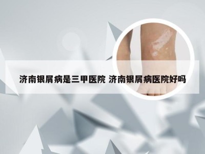 济南银屑病是三甲医院 济南银屑病医院好吗