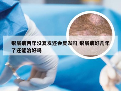 银屑病两年没复发还会复发吗 银屑病好几年了还能治好吗