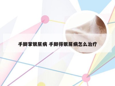手脚掌银屑病 手脚得银屑病怎么治疗