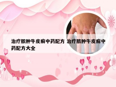 治疗脓肿牛皮癣中药配方 治疗脓肿牛皮癣中药配方大全