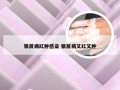 银屑病红肿感染 银屑病又红又肿