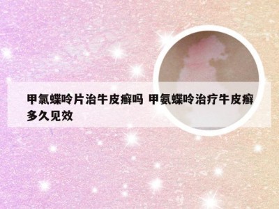 甲氯蝶呤片治牛皮癣吗 甲氨蝶呤治疗牛皮癣多久见效