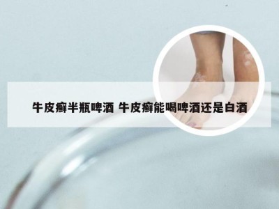 牛皮癣半瓶啤酒 牛皮癣能喝啤酒还是白酒