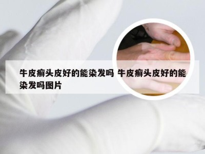 牛皮癣头皮好的能染发吗 牛皮癣头皮好的能染发吗图片